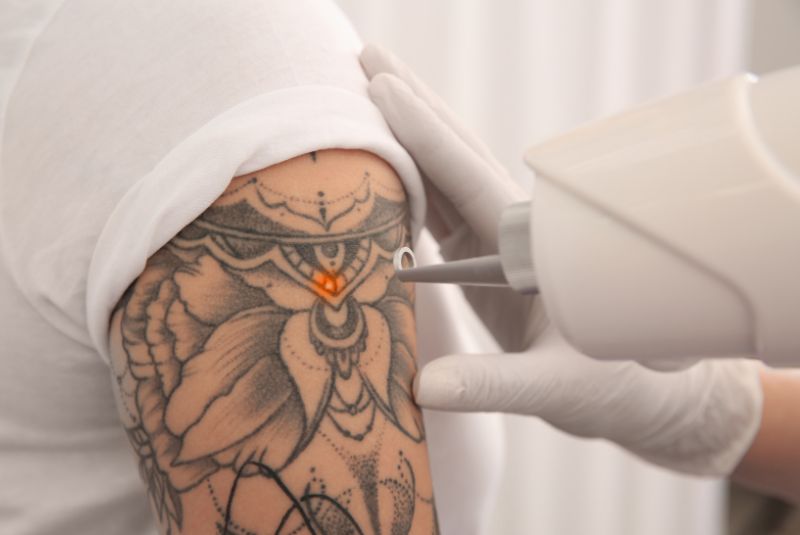 Eliminación de tatuajes con láser